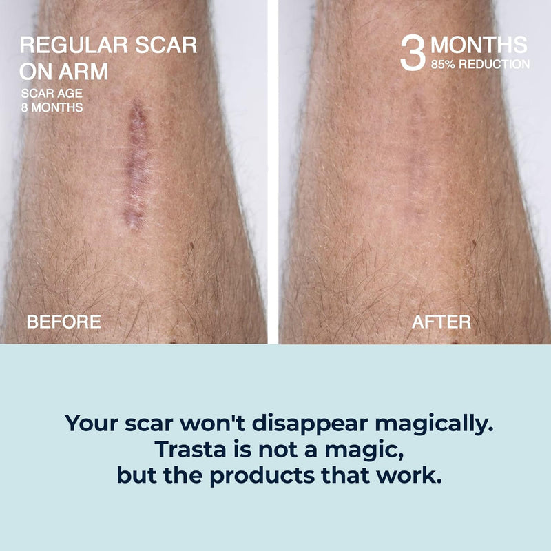 Silicone Scar Sheets – Silicone Scar Tape for Scar Treatment, Reusable Scar Removal Sheets – (1.6"x60"), Silicone Scar Bandages for Burns, Surgery, Keloid, Acne, Tummy Tuck, C-Section