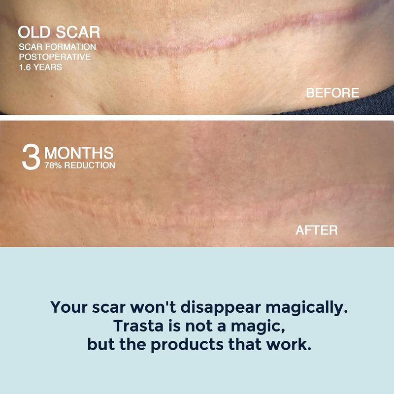 Silicone Scar Sheets – Silicone Scar Tape for Scar Treatment, Reusable Scar Removal Sheets – (1.6"x60"), Silicone Scar Bandages for Burns, Surgery, Keloid, Acne, Tummy Tuck, C-Section
